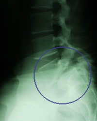 Spondylolisthesis X-ray