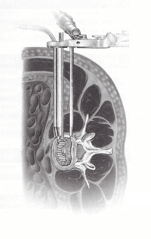 XLIF Retractor Opened