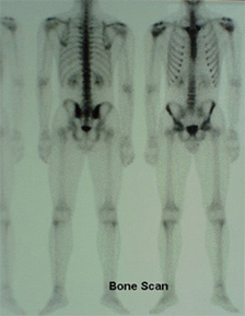 Bone Scan