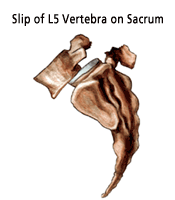 L5 Spondylolisthesis