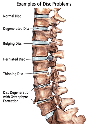 Degenerative Disc Disease Anatomy