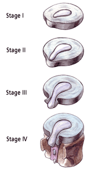 Disc Herniation Stages