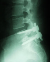 Spondylolisthesis Post Correction X-ray