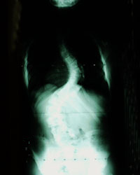 Spinal X-Ray Sample