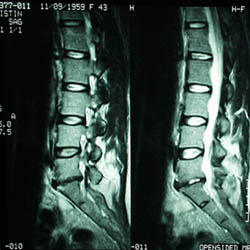 Degenerative Disc Disease MRI