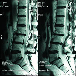 Spondylolisthesis MRI