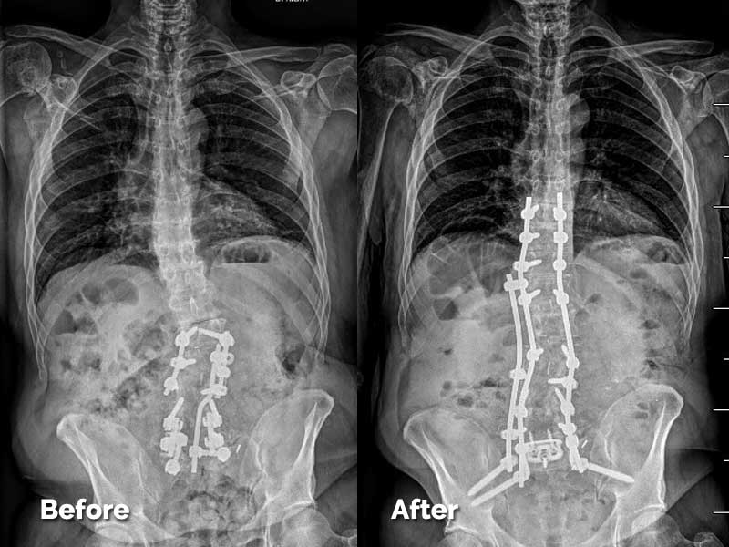 Michael Before After XRay 2022AR