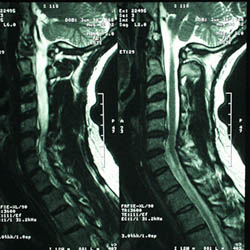 Cervical MRI